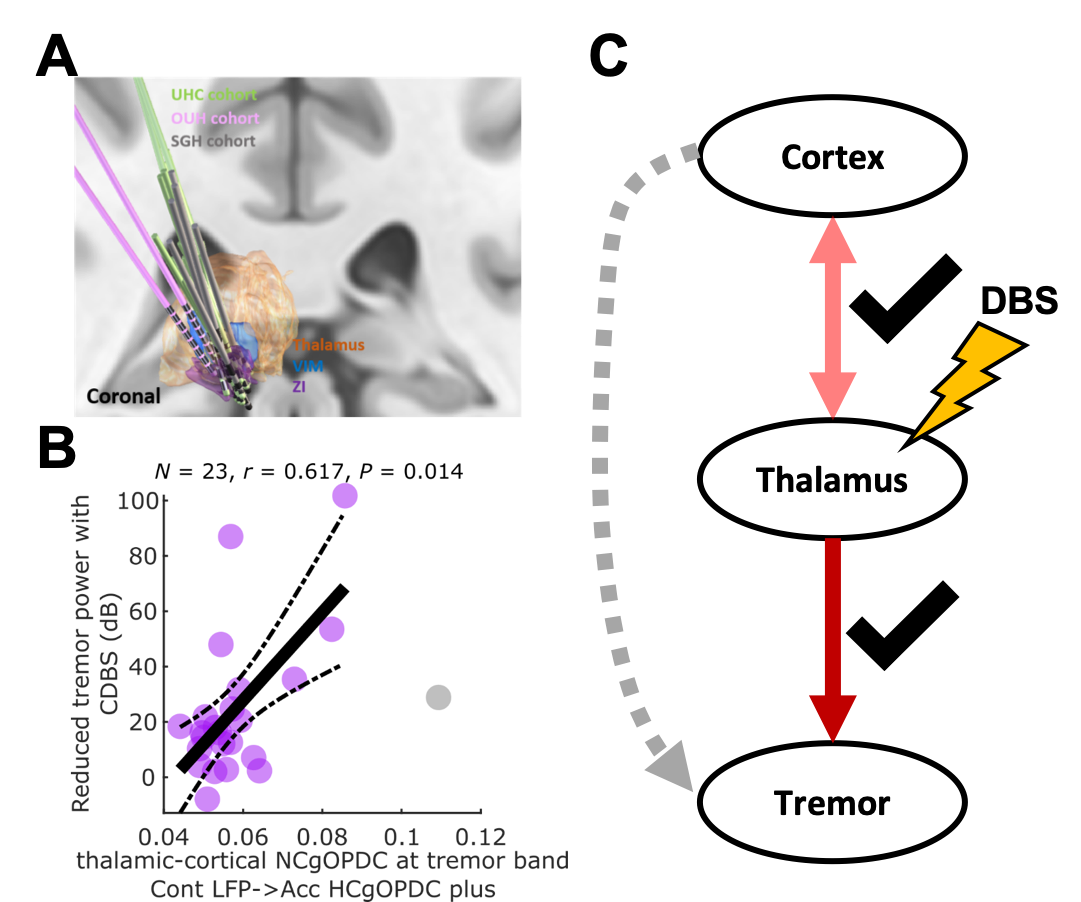 Figure with electrode locations on a coronal brain image, a scatter plot of connectivity against tremor reduction with deep brain stimulation, and a diagram linking cortex, thalamus and tremor.