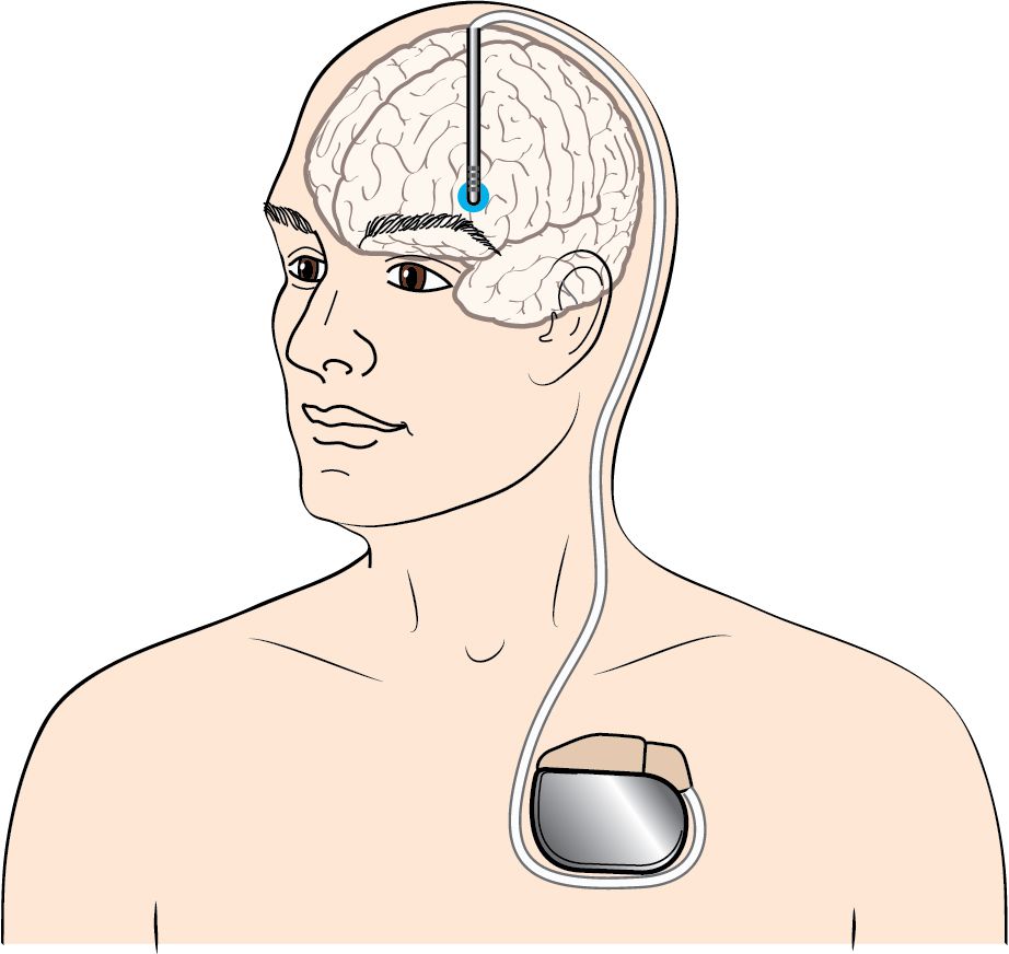 Illustration of a deep brain stimulation system: an electrode in the brain connected by a lead under the skin to a pulse generator in the chest.